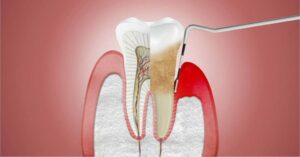 PERIODONCIA